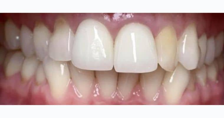 Before. Frontal view of the teeth showing a slight misalignment in the upper front teeth, with the dental midline slightly off-center. The upper right lateral incisor is rotated, and the overall arch appears mildly crowded.