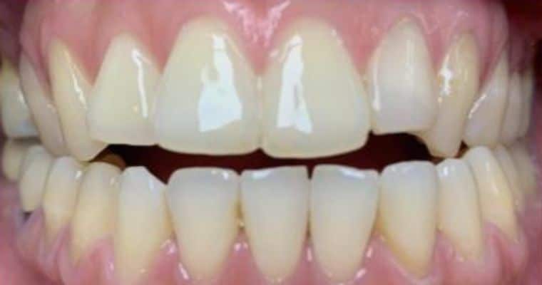 Before. Frontal view of teeth showing an open bite, where the upper and lower front teeth do not touch when biting down. There is also mild crowding in the lower front teeth, and the bite appears unbalanced.