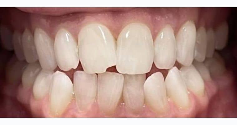 Before. Frontal view of teeth showing moderate crowding in the lower arch and a noticeable open bite, where the upper and lower front teeth do not meet when biting down. The front teeth are also slightly flared forward.