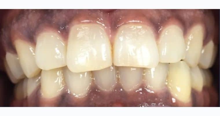 After. Same view after Invisalign treatment. The teeth are now well-aligned, with improved spacing and symmetry across both arches. The bite is more balanced, and the overall appearance is cleaner and more harmonious.