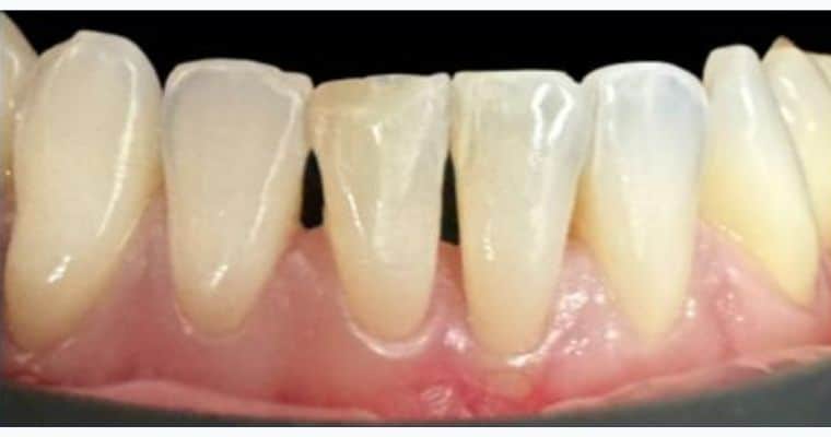 Before. Close-up of lower front teeth showing several black triangles — noticeable gaps between the teeth near the gumline caused by gum recession and loss of tissue volume. These dark spaces create a shadowed, uneven appearance.