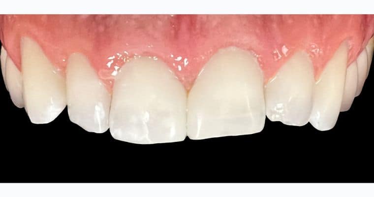 After. Same view after treatment. The space between the front teeth has been closed, and the edges have been reshaped for a smooth, symmetrical look. The front teeth now appear evenly spaced and natural.
