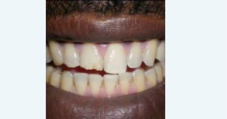 Before.Close-up of a smile showing a noticeable chip on the upper left front tooth (tooth #9). The enamel is visibly broken along the bottom edge, creating an uneven shape that stands out against the neighboring teeth.