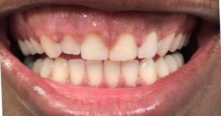 Before. Close-up of a smile showing noticeable wear and irregular edges on the upper front teeth. Several teeth appear shorter and more translucent near the tips, and the gumline shows some variation in height.